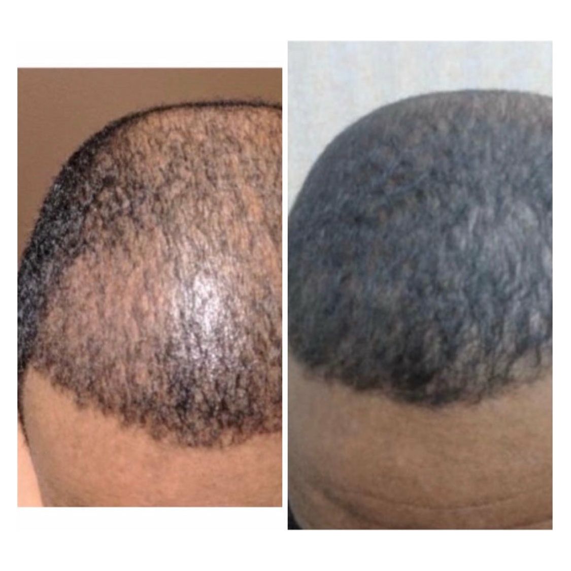 Advanced Hair Growth+ Supplements - (has Shellfish)