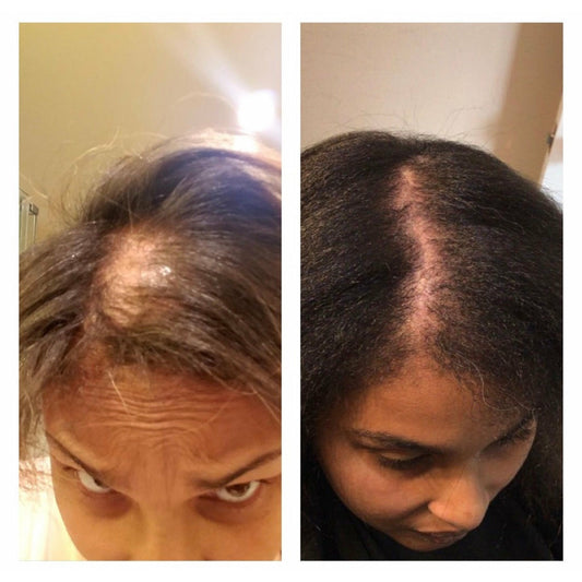 Advanced Hair Growth System (For Balding/Aggressive Thinning) | 3-Month Supply